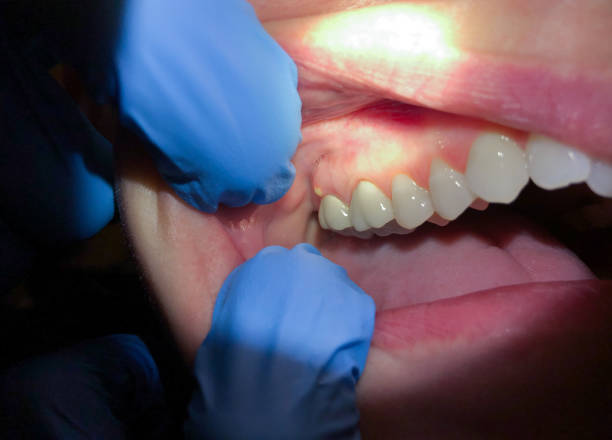 Best Emergency Dentist for Knocked-Out Tooth in Bannockburn, IL